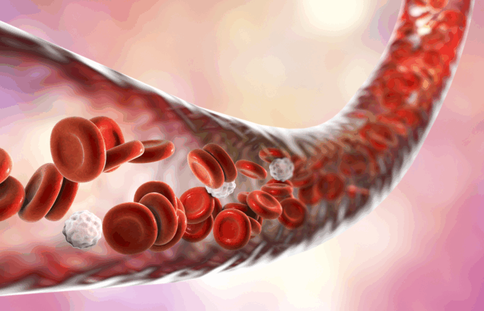 Blodkarl-inflammation-plack-sjudkom-åderförkalkning