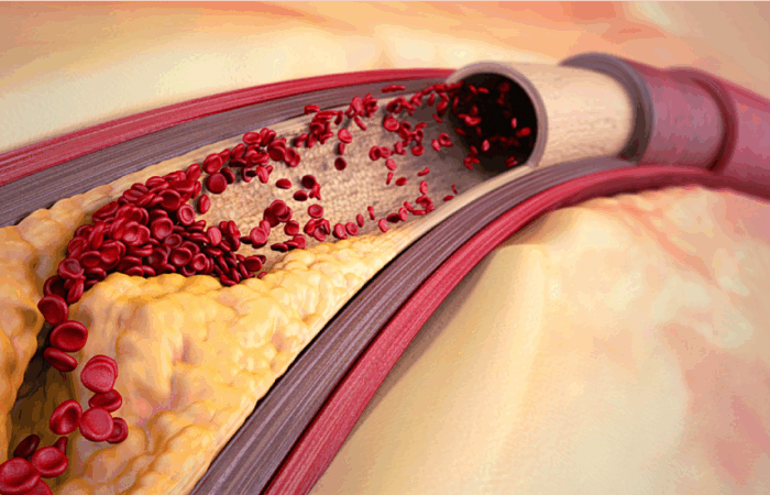 kärlkramp-bröstsmärta-blodkärl-åderförfettning